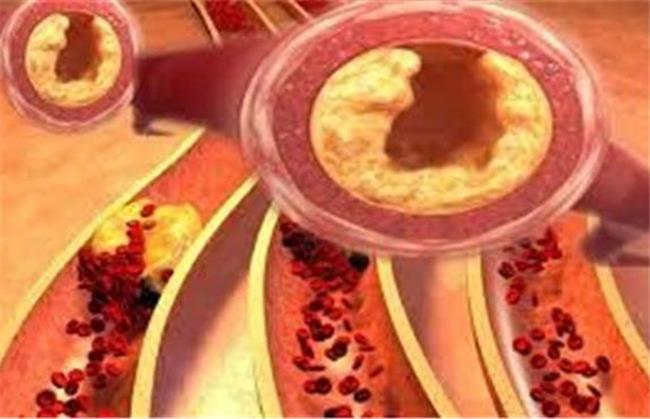 برای کاهش چربی خون چی بخوریم؛ راهنمایی یک متخصص
