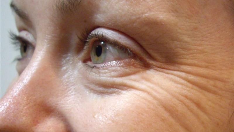 برای رفع و از بین بردن خطوط پنجه کلاغی چه کار کنیم؛ درمان های خانگی