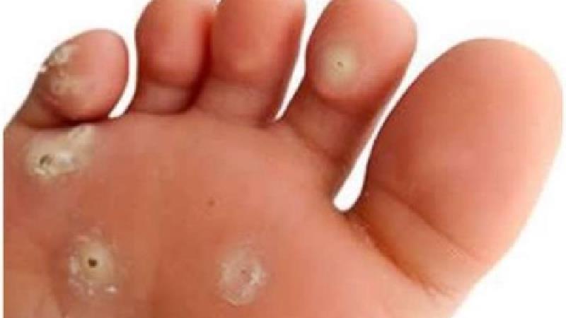 درمان میخچه و پینه با روش های خانگی و طب سنتی