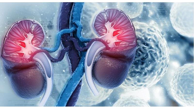 سرطان کلیه چه علائمی دارد + روش تشخیص