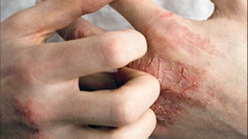 نحوه درمان خانگی و سنتی حساسیت پوستی