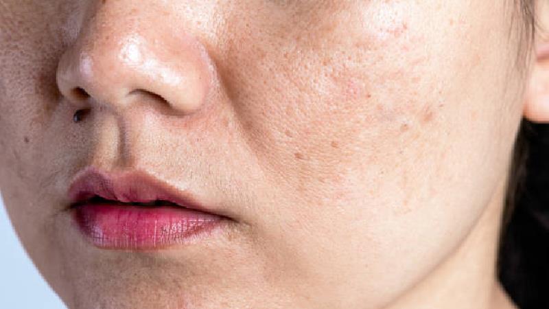 برای صورت چرب و جوش‌ دار چه کنیم؛ از ماسک تا روش های خانگی