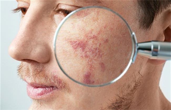 معرفی از بین برنده لک صورت؛ فوری و طبیعی