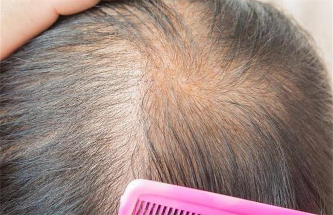 درمان گیاهی ریزش مو؛ موثرترین روش ها