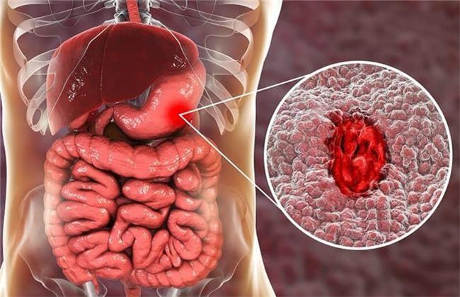 برای درمان زخم معده چی بخوریم