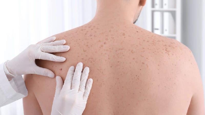 سرطان پوست چگونه مشخص می شود و ملانوم چیست