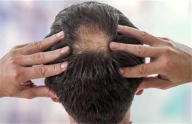 برای جلوگیری از ریزش مو چی بخوریم