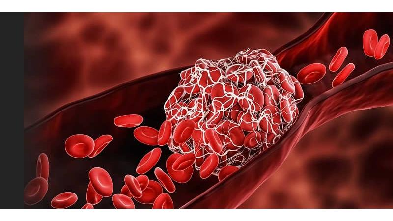 وجود لخته خون در بدن چه علائمی دارد