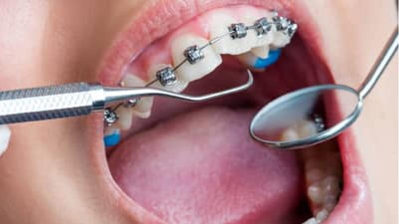 بهترین زمان برای ارتودنسی چه سنی است