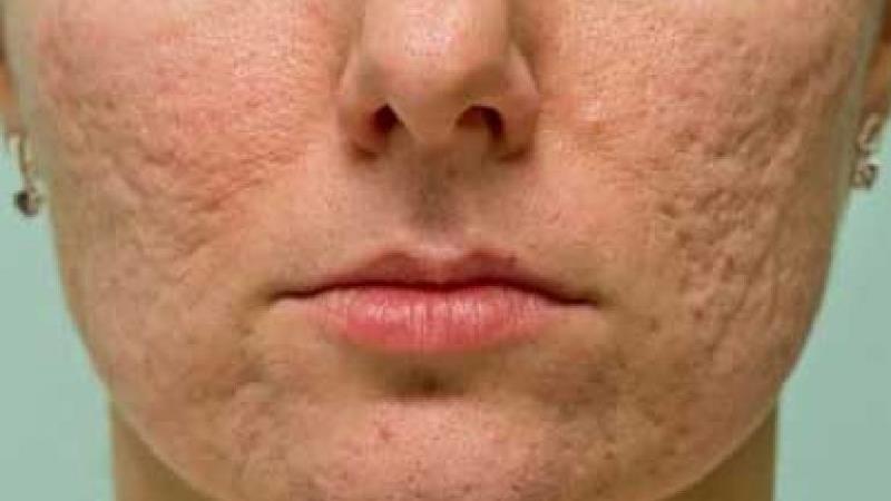 اسکار صورت چیست و چگونه درمان می شود