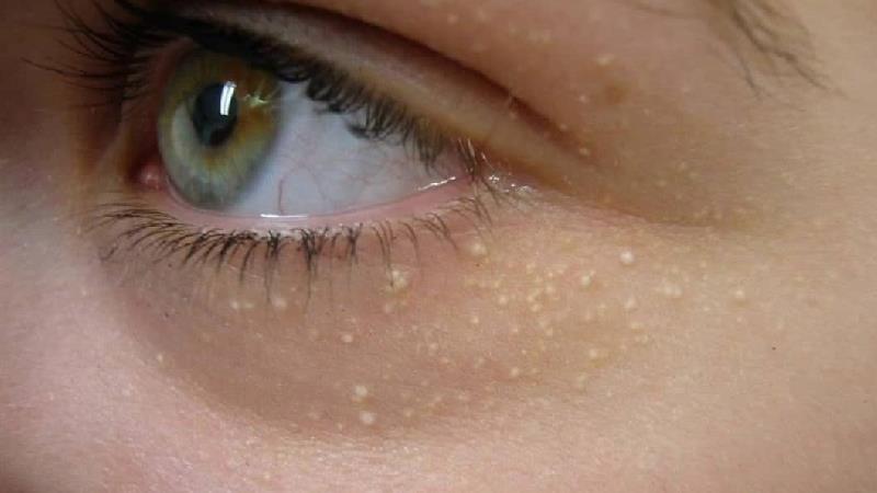 میلیا پوستی چیست و چگونه درمان می شود