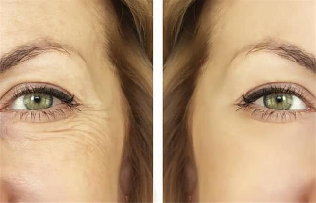 چروک صورت را چگونه از بین ببریم؛ روش های طبیعی