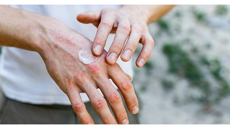 برای رفع خشکی دست چه کار کنیم