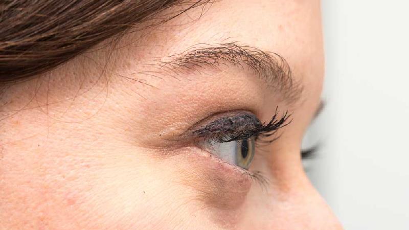 برای سیاهی زیر چشم چه کار کنیم + علت ها