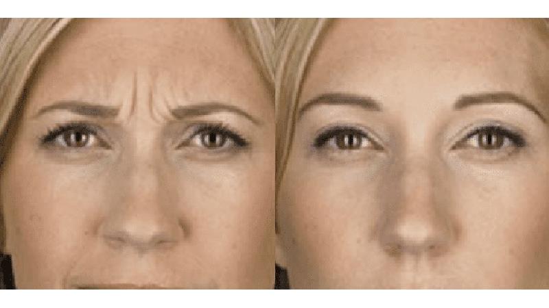 خط اخم را چگونه از بین ببریم؛ راه های طبیعی و خانگی