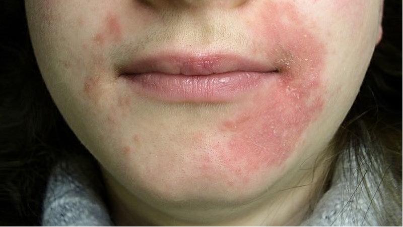 علت اگزمای صورت چیست و چه باید کرد