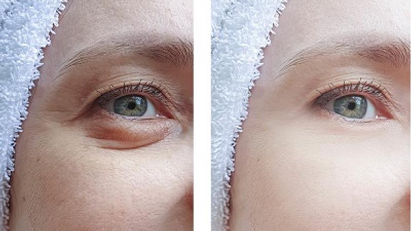 روش های طبیعی و خانگی برای برطرف کردن پف زیر چشم