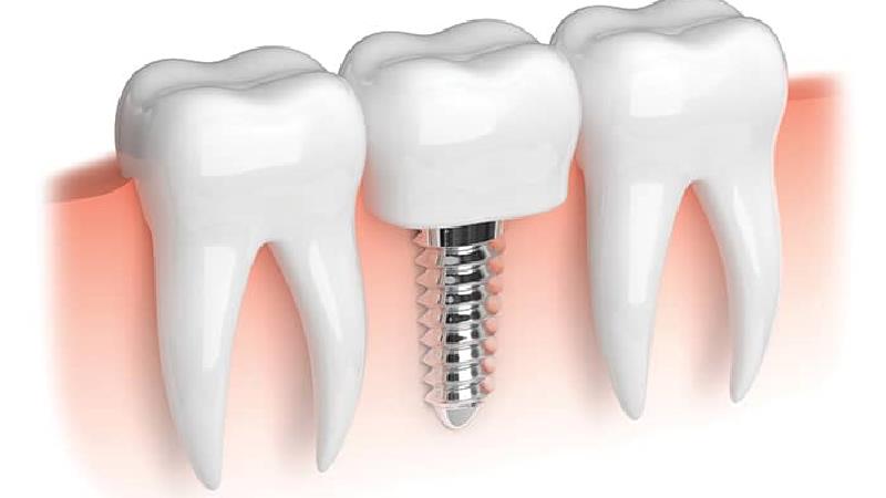 چه افرادی می‌توانند از ایمپلنت استفاده کنند؟