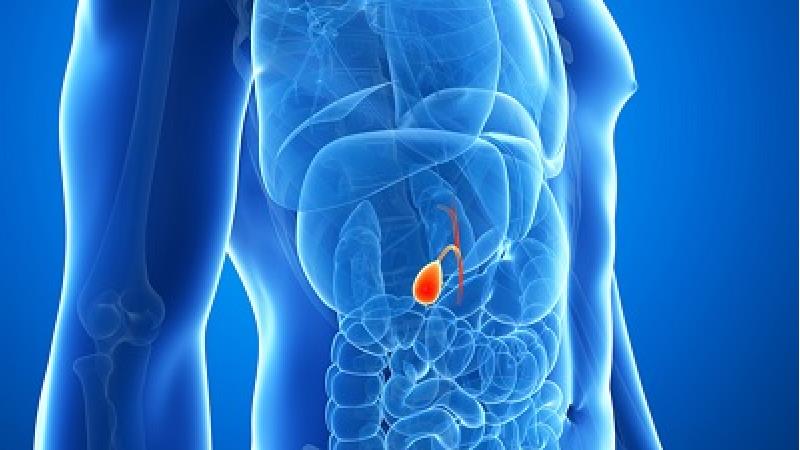 درمان سنگ کیسه صفرا با طب سنتی