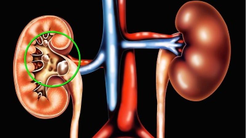 روش های درمان سنگ کلیه در طب سنتی؛ خوراکی های مفید و مضر