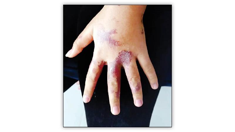 کابوس های زنی که قربانی اسیدپاشی شد