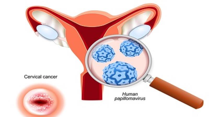 واکسن تا چه میزان در پیشگیری از سرطان دهانه رحم موثر است