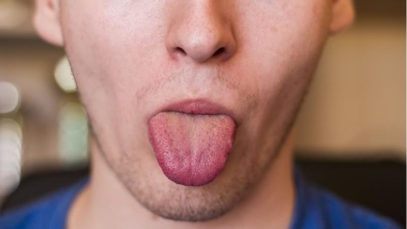 بی حسی و سوزش زبان نشانه چیست