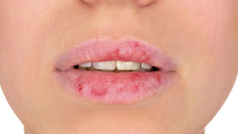 برای رفع خشکی لب ها چی خوب است