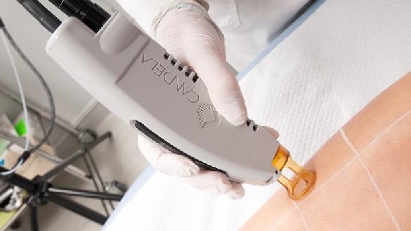 مقایسه دستگاه لیزر تیتانیوم و اکساندرایت از نظر اثربخشی