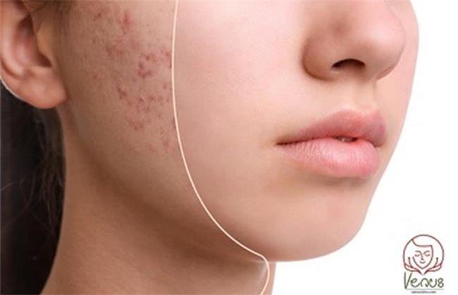 چگونه از شر جوش صورت خلاص شویم؟