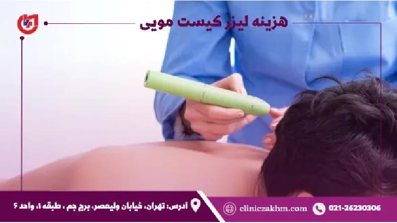 هزینه درمان کیست مویی با لیزر در سال 1402 چقدر است؟