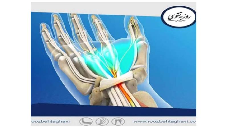 همه چیز در مورد سندروم تونل کارپال