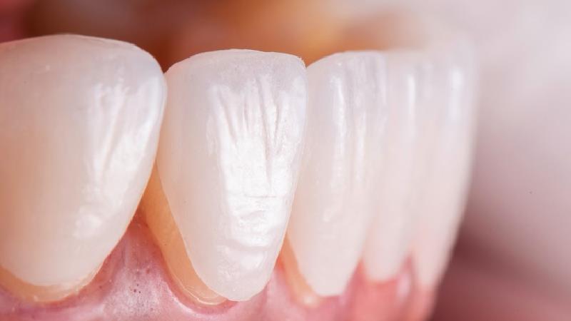 چگونه عمر لمینت دندان هایتان را افزایش بدهید؟