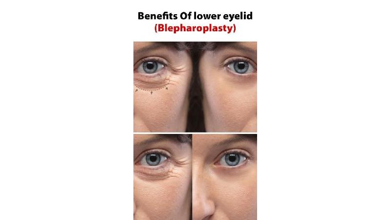 راهنمای کامل بلفاروپلاستی: از مشاوره تا بهبودی