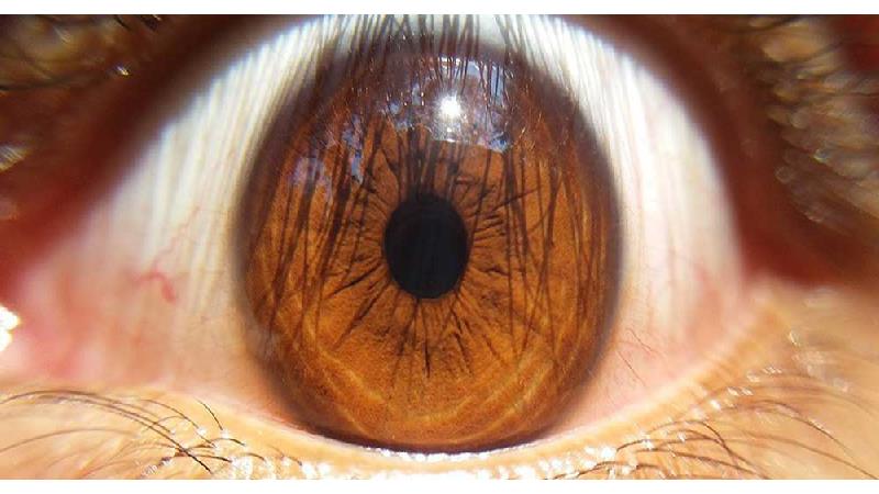 علل و علائم سکته چشمی چیست و راه درمان آن چگونه است