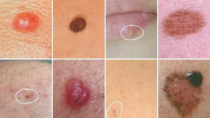 نمونه عکس‌های سرطان پوست: راهنمای جامع برای شناسایی و پیشگیری