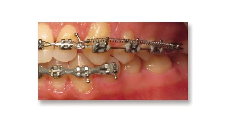 نقش کویل اسپرینگ در درمان ارتودنسی