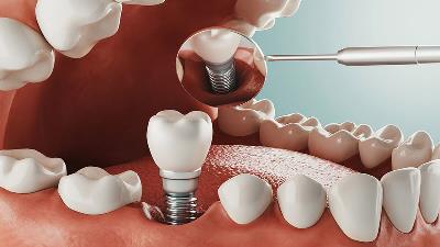 صفر تا صد ایمپلنت فوری در تهران