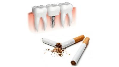 تاثیر سیگار در میزان موفقیت ایمپلنت دندان