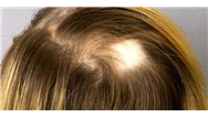 دلایل ریزش مو یا کچلی سکه‌ای و راه‌های درمان