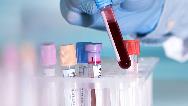 آزمایش خون کامل شامل چیست + دانستنی هایی درباره نتیجه آزمایش خون