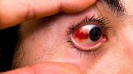 علت ایجاد لکه قرمز در چشم چیست