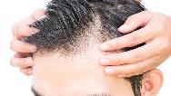 روش های جلوگیری از ریزش مو با طب سنتی