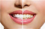 دلایل اصلی زرد شدن دندان ها چیست