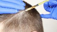 مزوتراپی مو چیست و چه فایده ها و عوارضی دارد