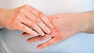 درمان سریع خشکی پوست دست و صورت در طب سنتی