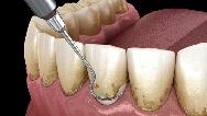 آیا جرم‌گیری دندان ضرر دارد؟