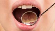 جرم دندان با چه موادی در خانه پاک می شود