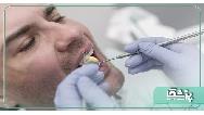 ایمپلنت دندان و مراقبت های پس از آن [آپدیت 2023] ✔️
