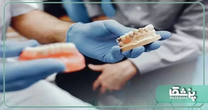 چه کسانی به ایمپلنت دندان نیاز دارند؟